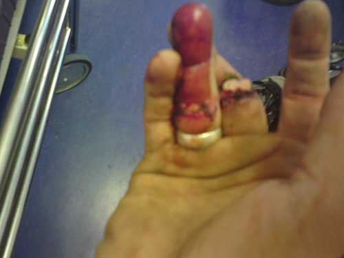 Bilder-Thread mybrokenhandSML