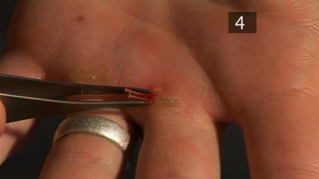 Bilder-Thread how-to-remove-a-splinter.WidePlayer