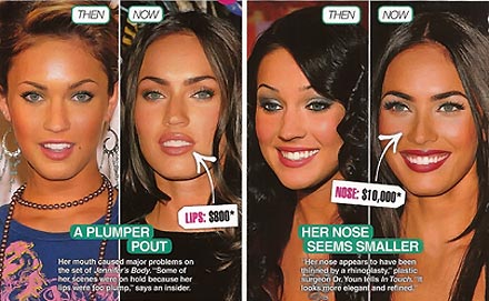 megan-fox-before-after-surgery-1-5