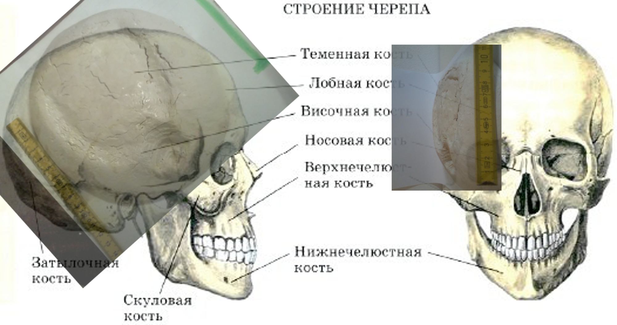 Скуловая и теменные кости. Перелом лицевого отдела черепа. Вдавленный перелом черепа. Скуловая кость анатомия. Неправильное строение черепа.