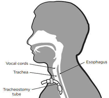 trach1