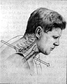 JFK neck cross-section
