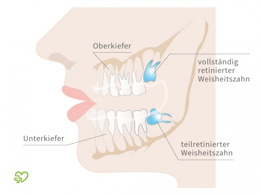 weisheitszahn-850x638