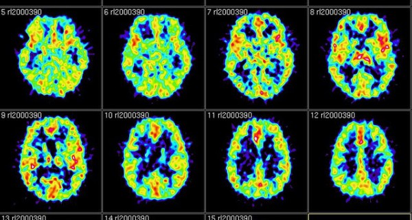 brain-scan-images-600x320