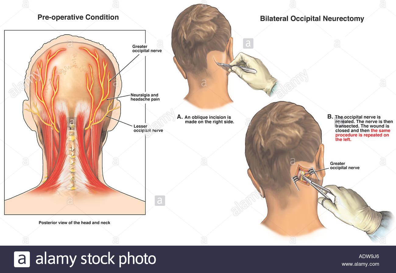headache-pain-occipital-neuralgia-with-s
