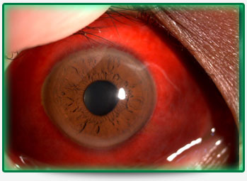 picture-subconjunctival-hemorrhages2