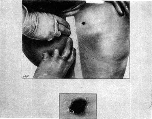 JFK posterior back wound