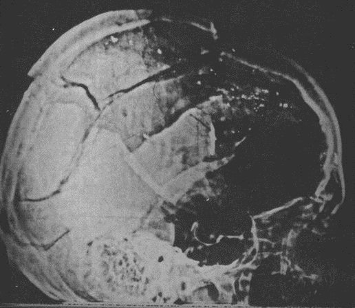 JFK-Xray-Lateral