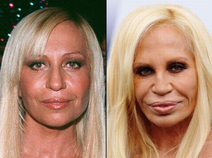 celebrities before and after plastic sur