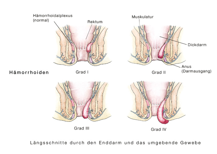 pop haemorrhoiden