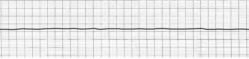 EKG Asystole