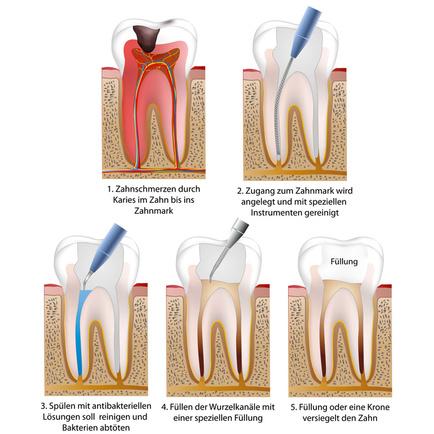 wurzelbehandlung 0