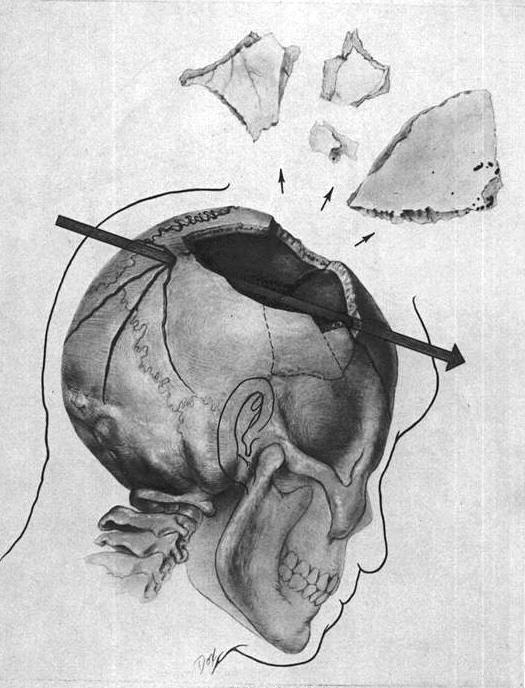 JFK skull trajectory