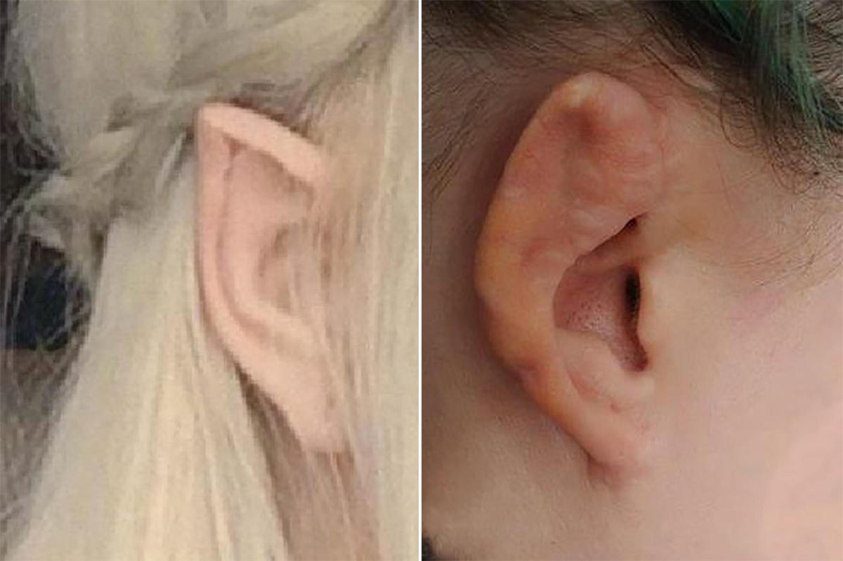161014-woman-ear-surgery-feature