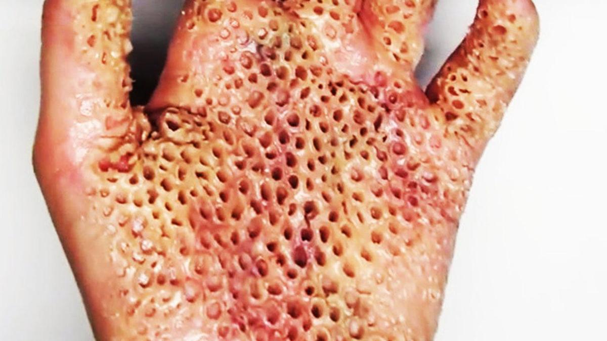 trypophobia-trypophobia-trypophobia-tryp