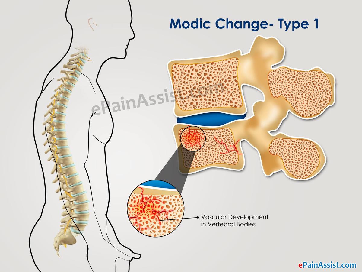 modic-change-type-1