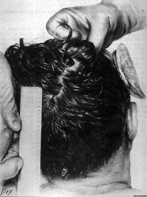 tfe5818 JFK posterior head wound