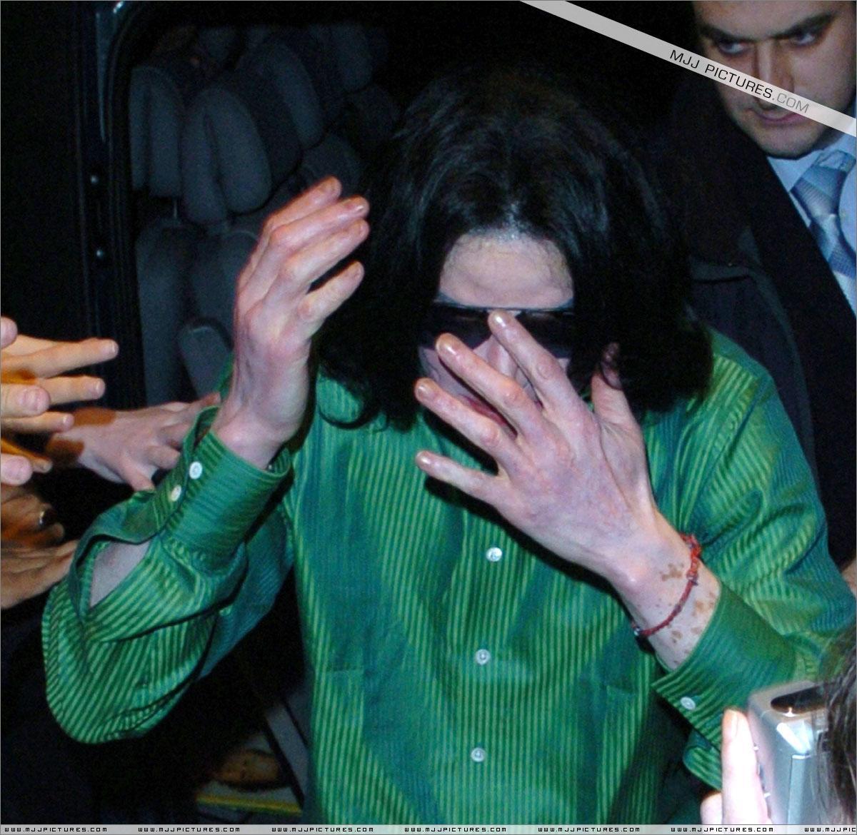7ttOd2 vitiligo london05