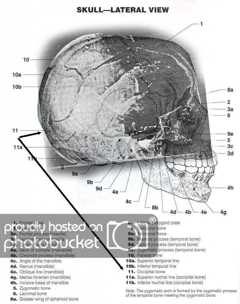 HoleinOccipital zps82b5a764