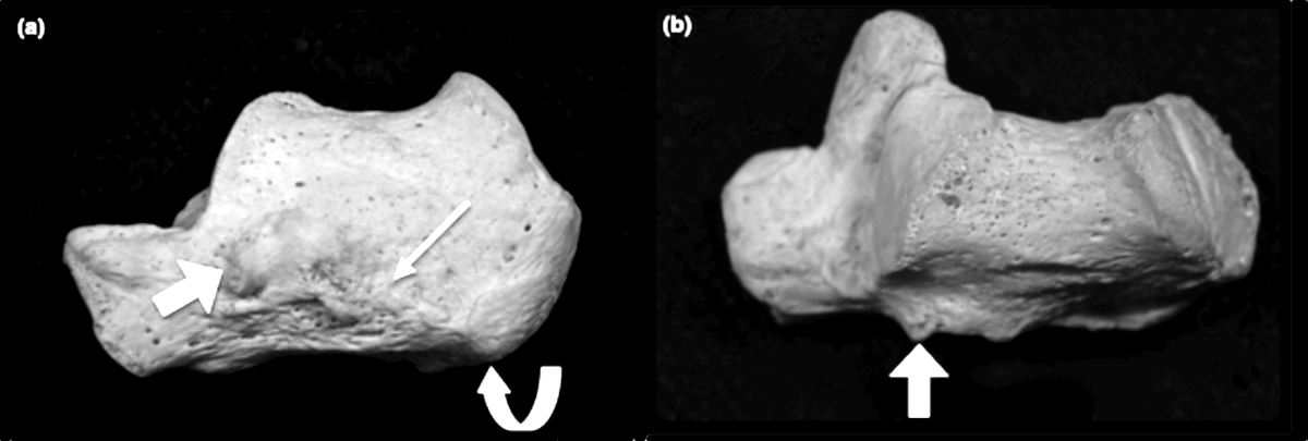 calcaneus