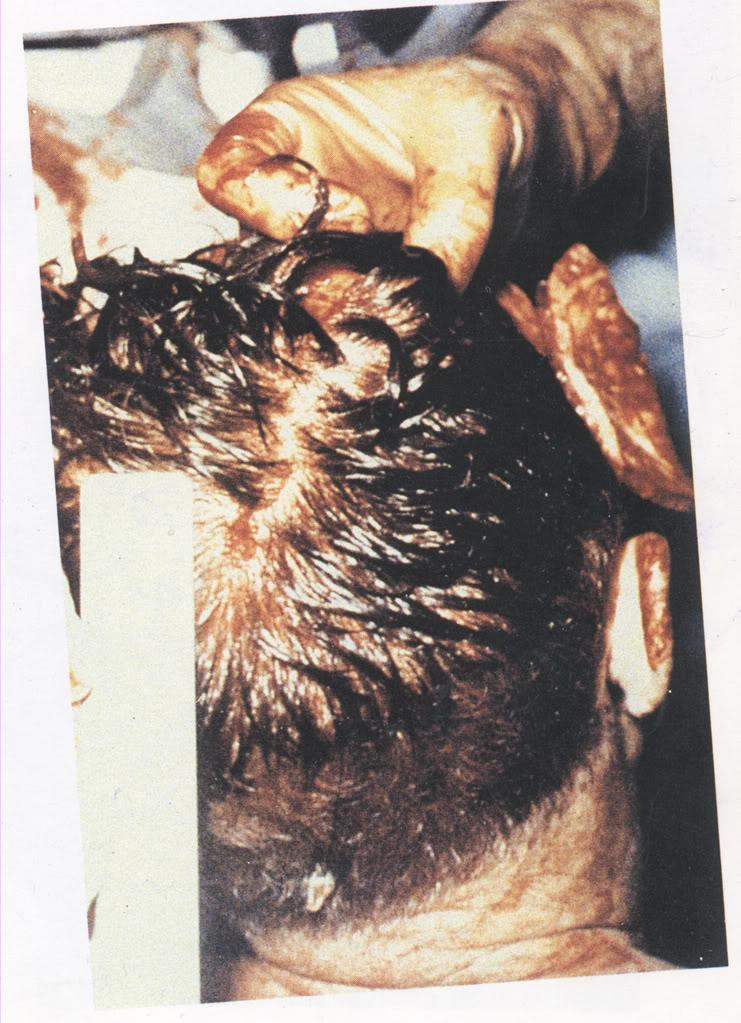 jfkcolor boh autopsy photo