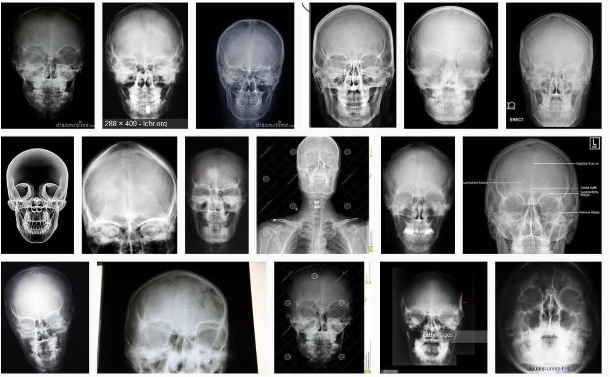 frontalskull