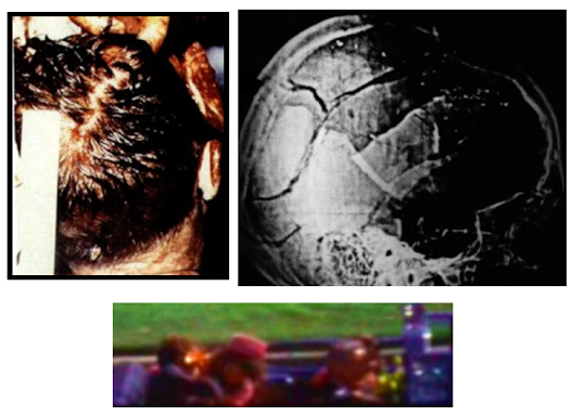 JFK-Head-Wound-Photographic-Comparison