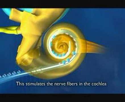 Youtube: Cochlear Implant Introduction