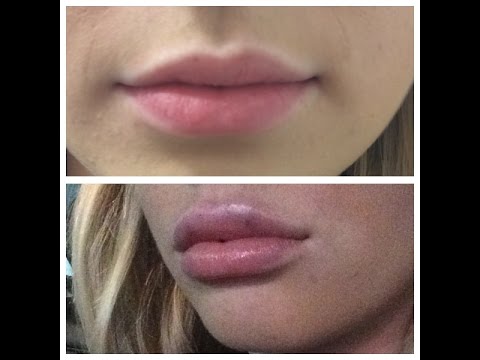 Youtube: Ich habe meine Lippen aufspritzen lassen! | MayaRe