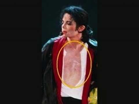 Youtube: Michael Jackson ~ Vitiligo
