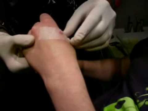 Youtube: RFID chip hand implantation