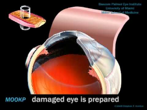 Youtube: Osteo-Odonto-Keratoprosthesis Procedure, Artwork by Stephen F. Gordon