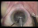 Youtube: Posterior Capsule Rupture