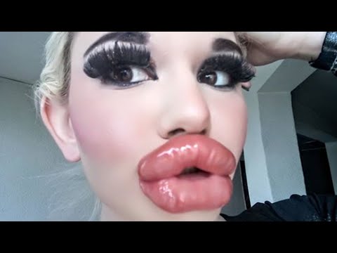 Youtube: Sie möchte die größten Lippen der Welt haben! Nach 20 OPs ist der Traum nah!