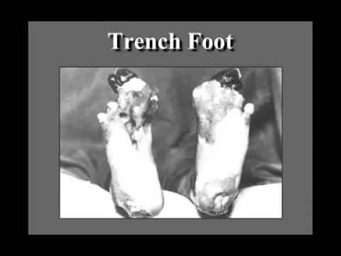 Youtube: WWI Trench Foot 1