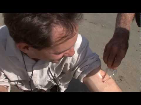 Youtube: Stung by a Box Jellyfish