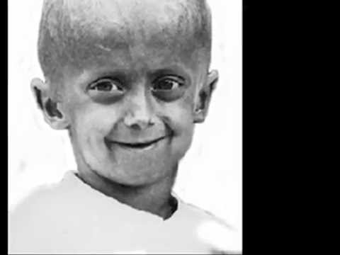 Youtube: Progeria Infantiles