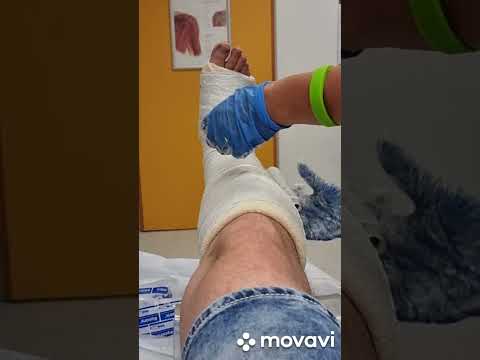 Youtube: Gipsverband anlegen Fuß