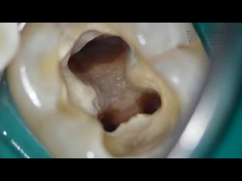 Youtube: Wie funktioniert eine Wurzelbehandlung beim Zahnarzt?