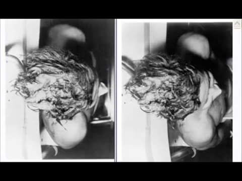 Youtube: 3D Photo of JFK Autopsy WARNING Graphic