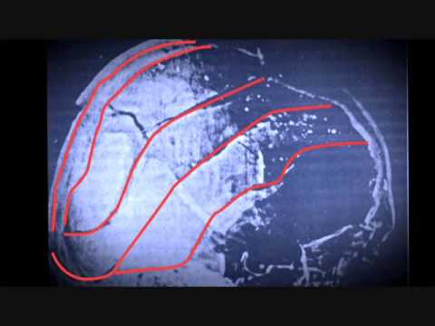 Youtube: JFK Skull Fracture Lines