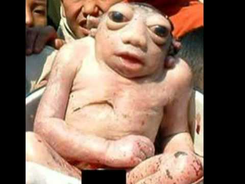 Youtube: Frog-like Baby (unidentified baby - Nepal)