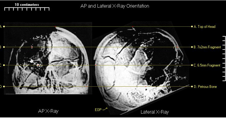 x Ray