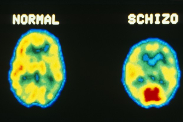 Schizophrenie-DW-Wissenschaft-Hamburg