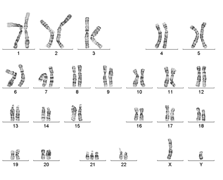 trisomie 21